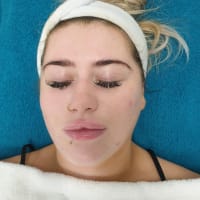 Acne scaring treatment to start this beauty on her journey