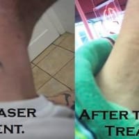 BRIGHTON ROAD TATTOO REMOVAL