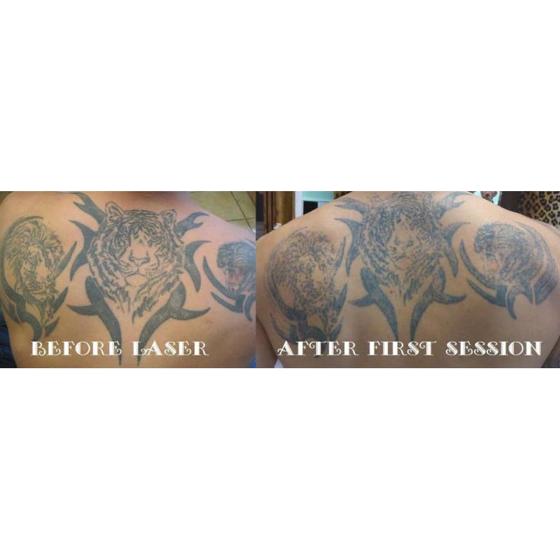 Fantastic results from just 2 sessions :-) #newskin #wrexham #tattooremoval  #lasertattooremoval #laserremoval #fadeth… | Tattoo removal, Tattoos, Skin  color tattoos