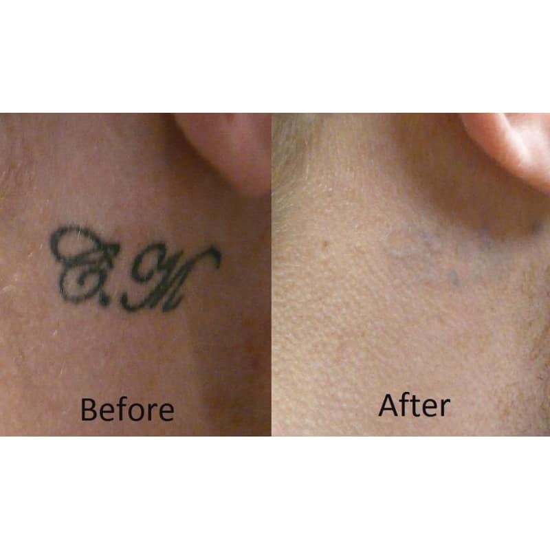 no regrets tattoo removal sutton coldfield tattoo removal yell no regrets tattoo removal sutton coldfield tattoo removal yell