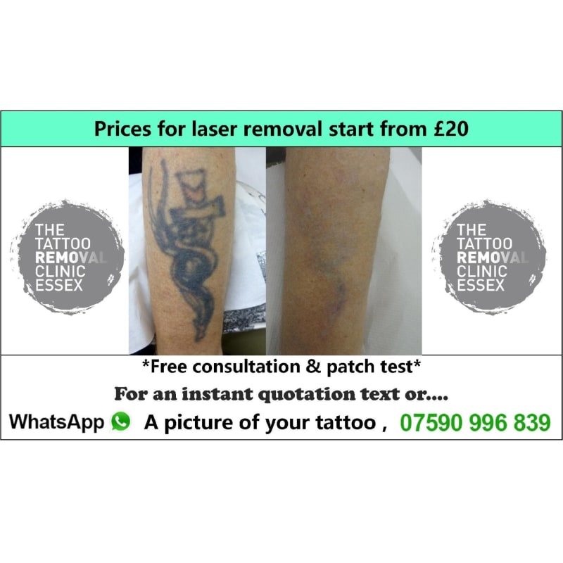 The Tattoo Removal Clinic Essex, Chelmsford | Tattoo Removal - Yell