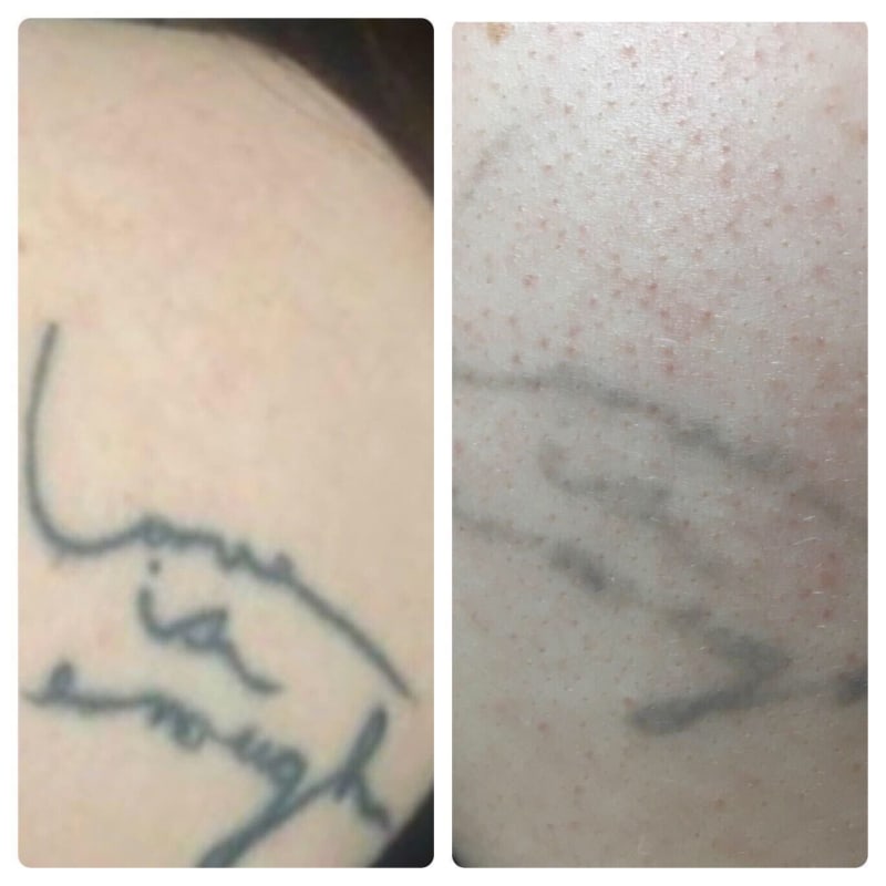 DIFFERENCE BETWEEN BLUE LIGHT AND RED LIGHT PICOSECOND LASER PEN AND THE  SCARS THEY CLEAR  YouTube